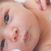 Yenidoğan Alerjileri