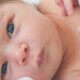 Yenidoğan Alerjileri